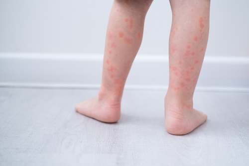 Bed Bug Bites on Babies Symptoms, Risks, and Remedies